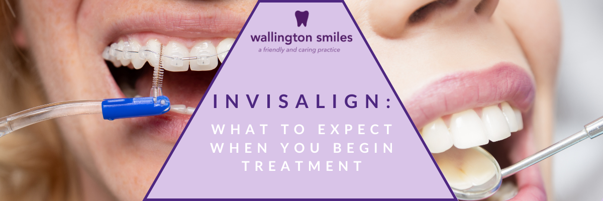 Invisalign: What to Expect When You Begin Treatment